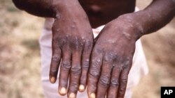 WHO Monkeypox 