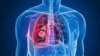 lung cancer အဆုတ်ကင်ဆာ