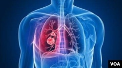 lung cancer အဆုတ်ကင်ဆာ